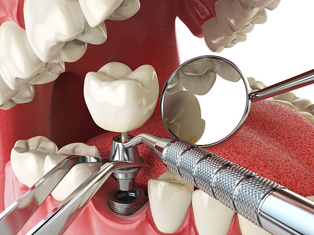 Best Emergency Root Canal Treatment in Plainfield, IL